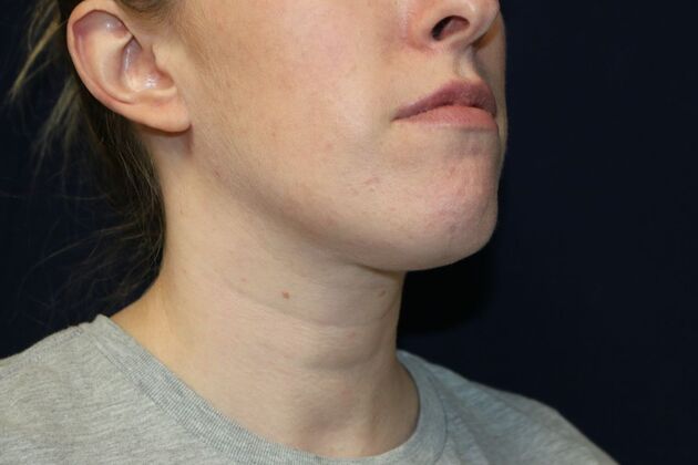Neck Sculpting : Case 11 - After