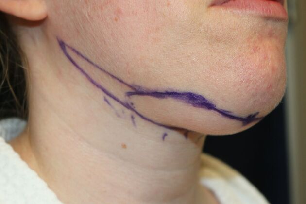 Neck Sculpting : Case 11 - Before