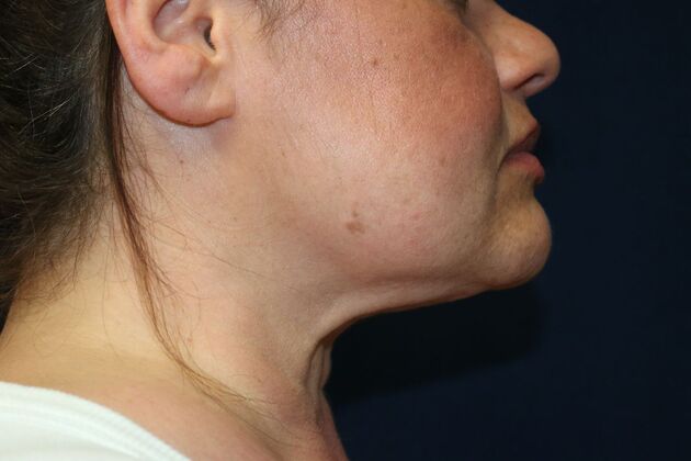 Neck Sculpting : Case 12 - Before