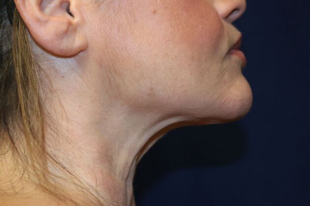 Neck Sculpting : Case 12 - After