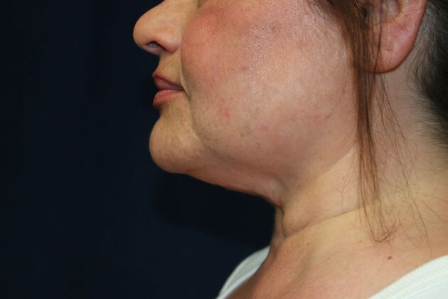 Neck Sculpting : Case 12 - Before