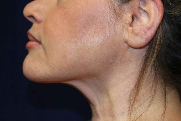 Neck Sculpting : Case 12 - After