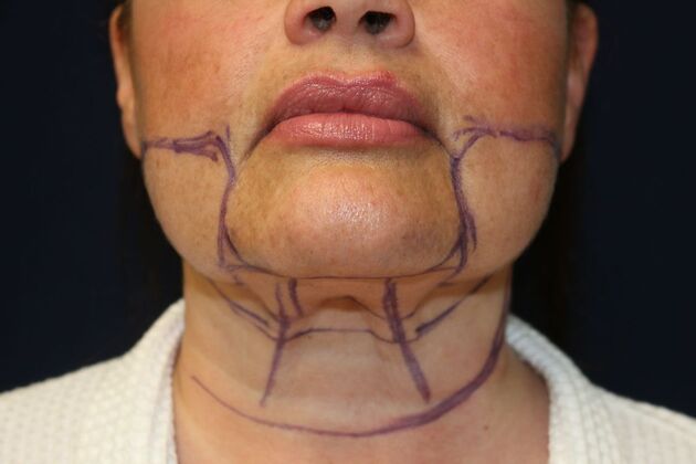 Neck Sculpting : Case 12 - Before