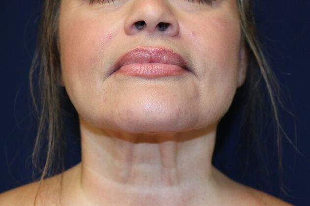 Neck Sculpting : Case 12 - After