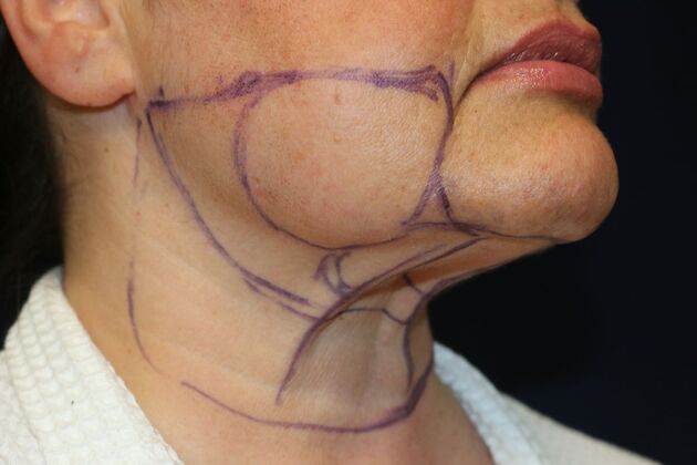 Neck Sculpting : Case 12 - Before