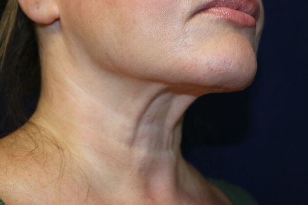 Neck Sculpting : Case 12 - After