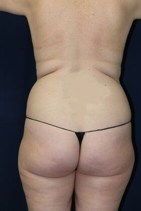 Liposuction & Safe Lipo: Case 56 - Before