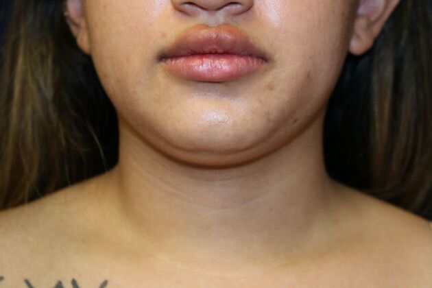 Neck Sculpting : Case 13 - Before