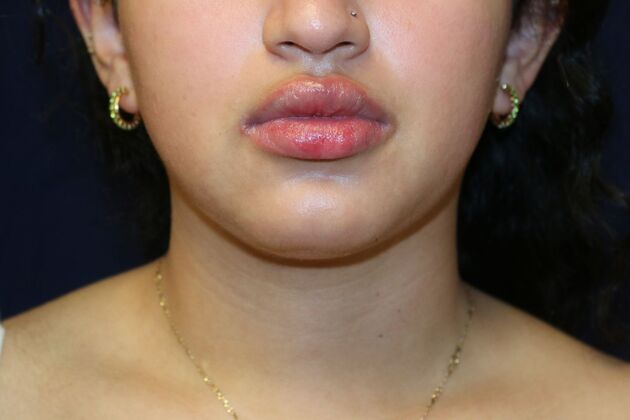 Neck Sculpting : Case 13 - After