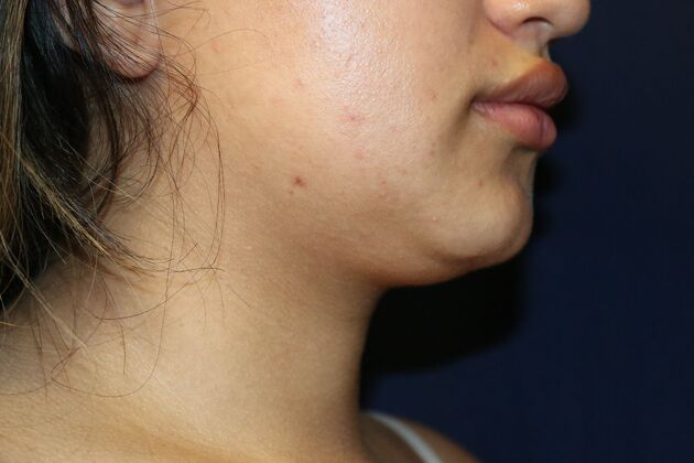 Neck Sculpting : Case 13 - Before