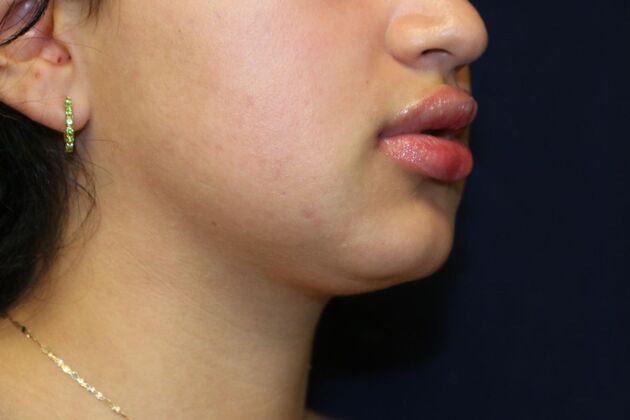 Neck Sculpting : Case 13 - After