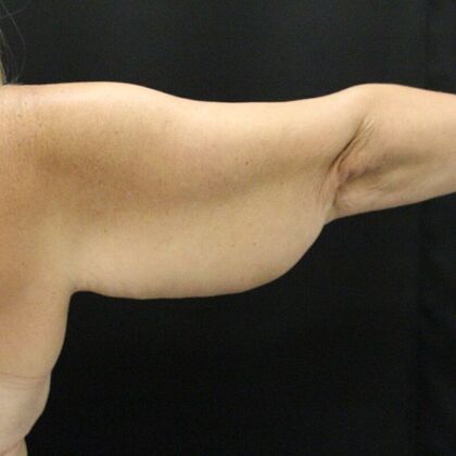 Arm Lift: Case 23 - Before