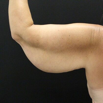 Arm Lift: Case 23 - Before