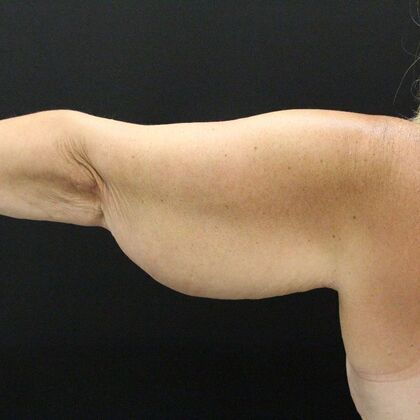 Arm Lift: Case 23 - Before