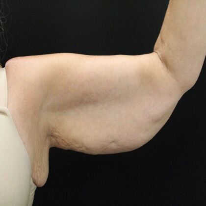 Arm Lift: Case 23 - Before