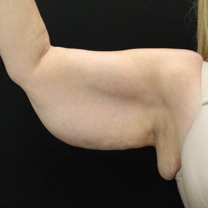 Arm Lift: Case 23 - Before