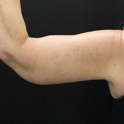 Arm Lift: Case 23 - After