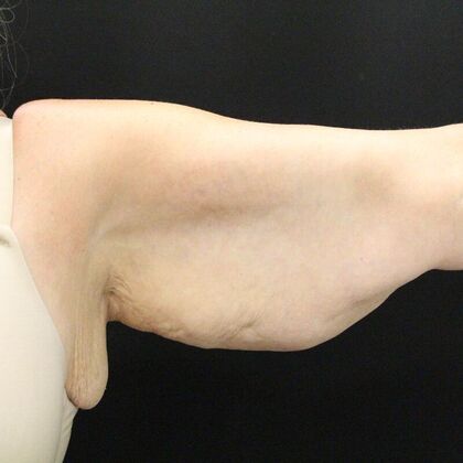 Arm Lift: Case 23 - Before