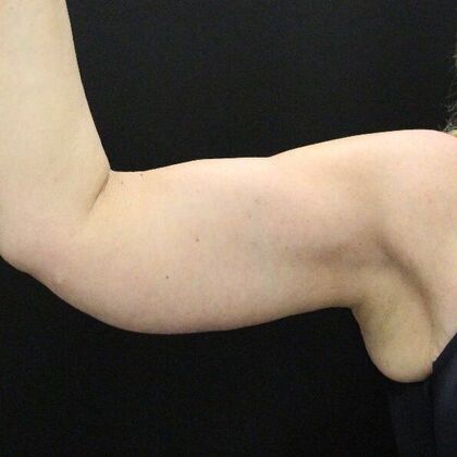 Arm Lift: Case 23 - After