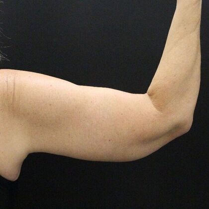 Arm Lift Case 23 - After