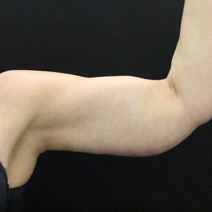 Arm Lift: Case 23 - After