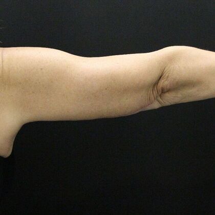 Arm Lift: Case 23 - After