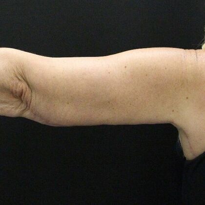 Arm Lift: Case 23 - After