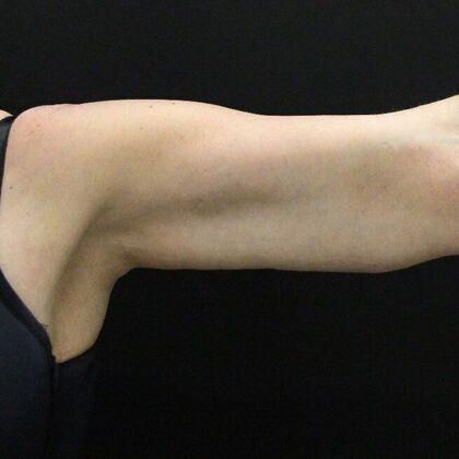 Arm Lift: Case 23 - After