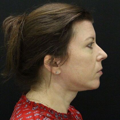 Face & Neck Lifts: Case 44 - After