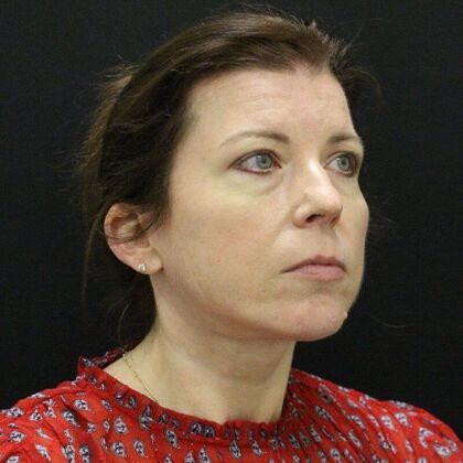 Face & Neck Lifts: Case 44 - After