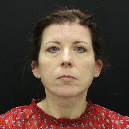 Face & Neck Lifts Case 44 - After