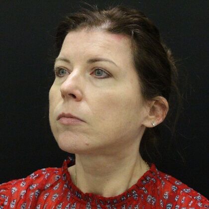 Face & Neck Lifts: Case 44 - After
