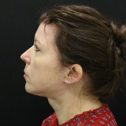 Face & Neck Lifts: Case 44 - After