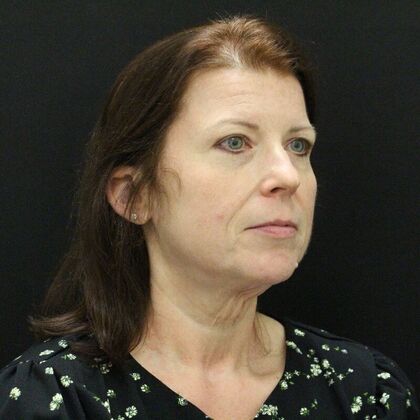 Face & Neck Lifts: Case 44 - Before