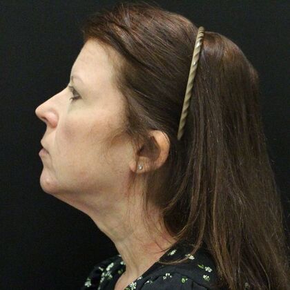Face & Neck Lifts: Case 44 - Before
