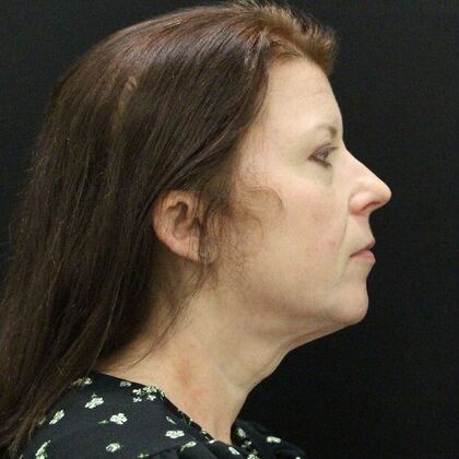 Face & Neck Lifts: Case 44 - Before