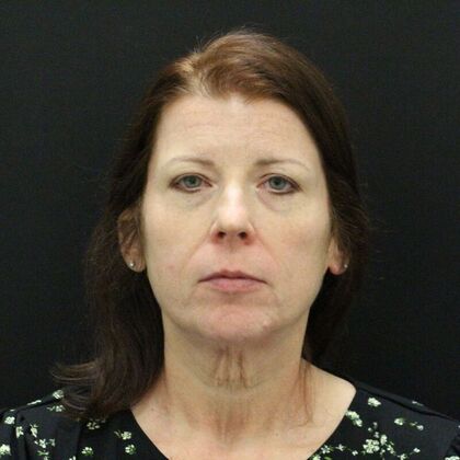 Face & Neck Lifts Case 44 - Before