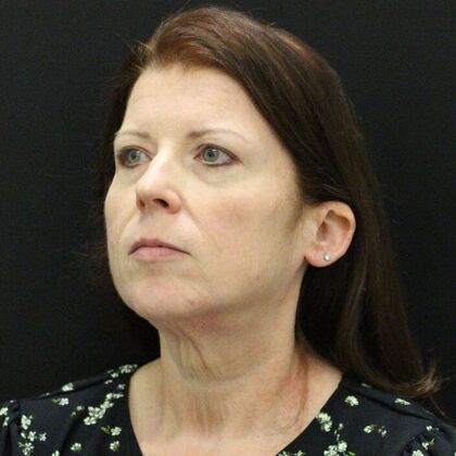 Face & Neck Lifts: Case 44 - Before