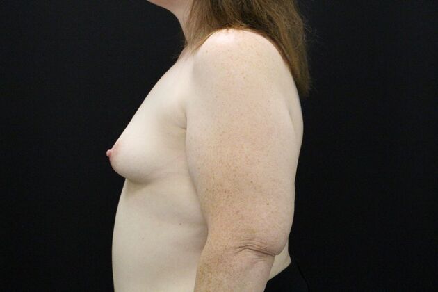 Breast Augmentation: Case 114 - Before
