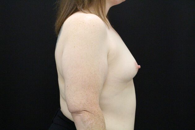 Breast Augmentation: Case 114 - Before
