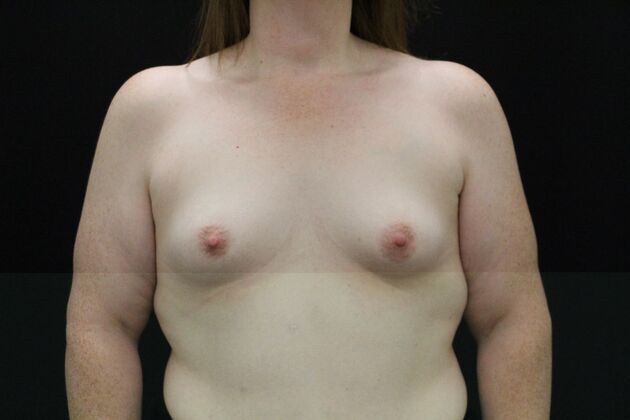 Breast Augmentation: Case 114 - Before