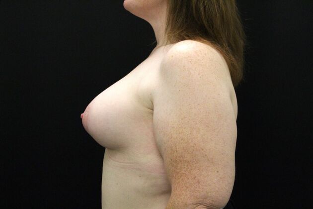 Breast Augmentation: Case 114 - After