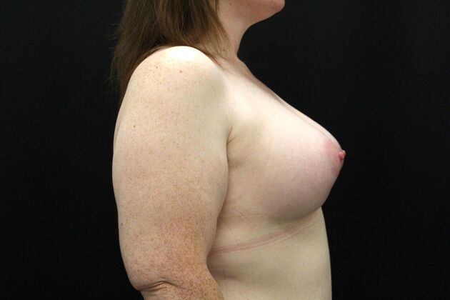 Breast Augmentation: Case 114 - After