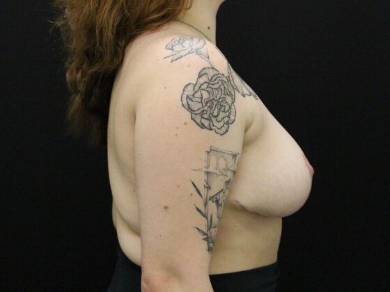 Breast Reduction: Case 28 - After