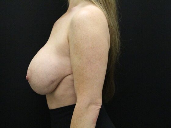 Breast Augmentation Exchange/Revision: Case 21 - Before