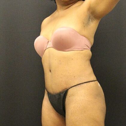 Liposuction Case 31 - After