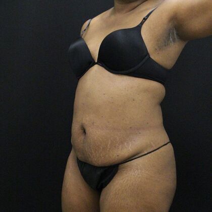 Liposuction Case 31 - Before