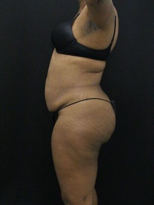 Liposuction: Case 31 - Before