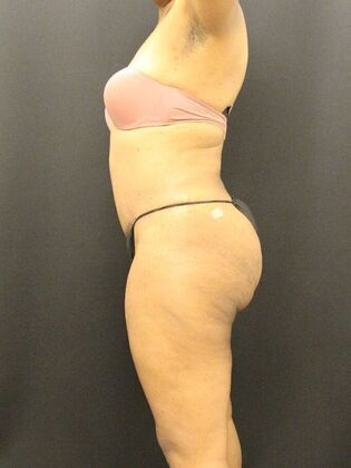 Tummy Tuck: Case 69 - After