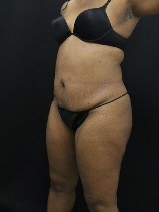 Tummy Tuck Case 69 - Before